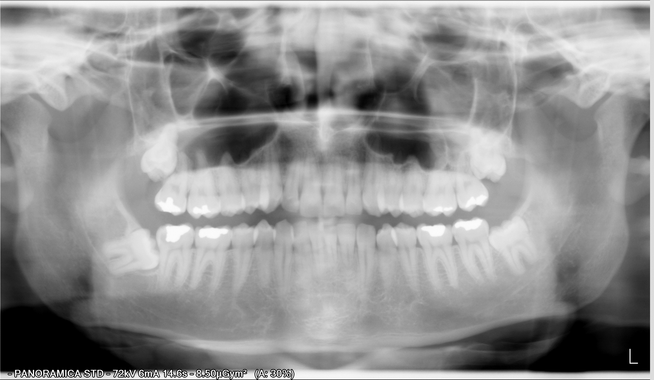 Di recente, ho accusato dolore al dente del giudizio inferiore destro